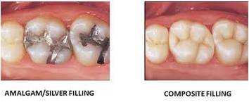 dental fillings